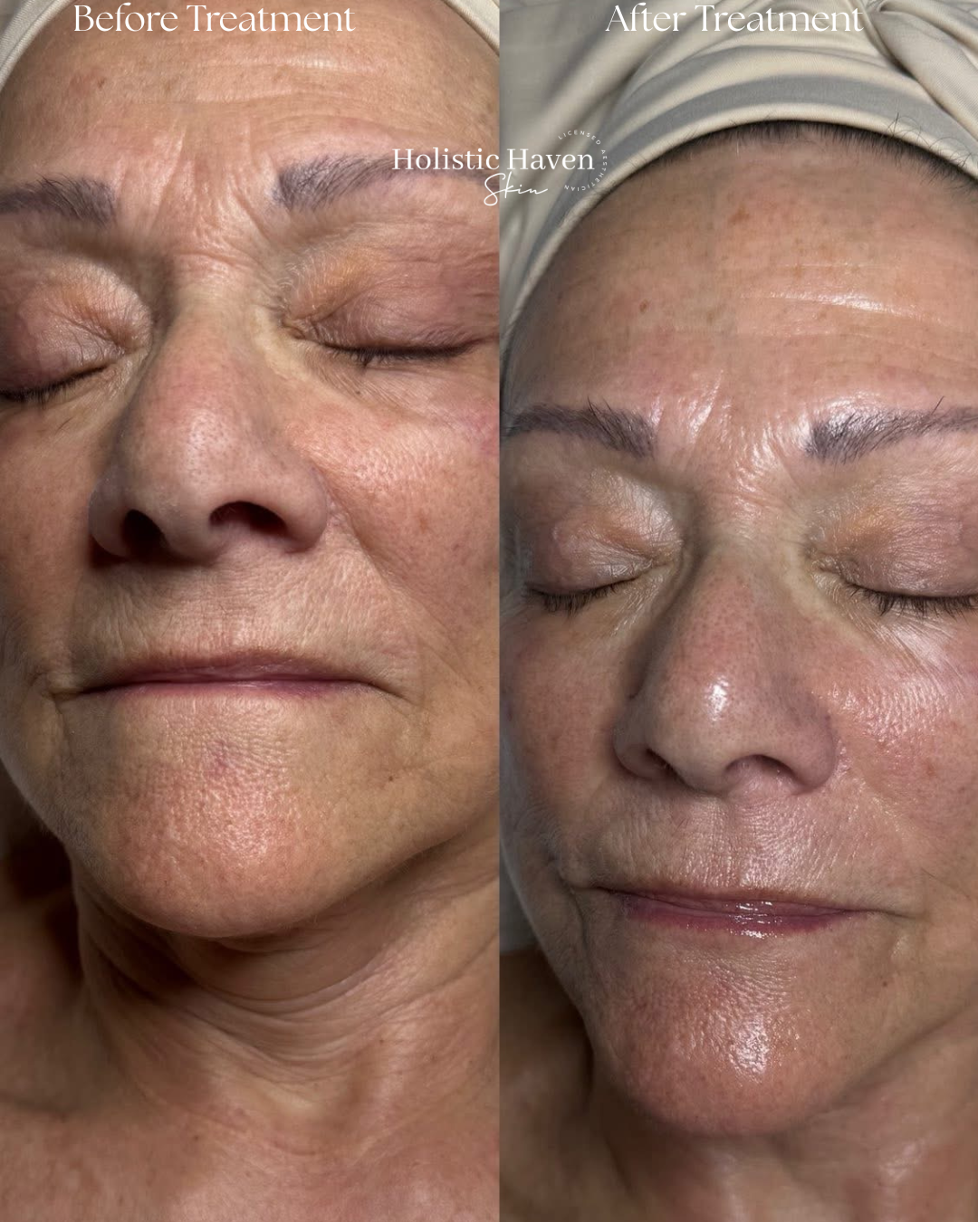 Client skin immediately before and after treatment