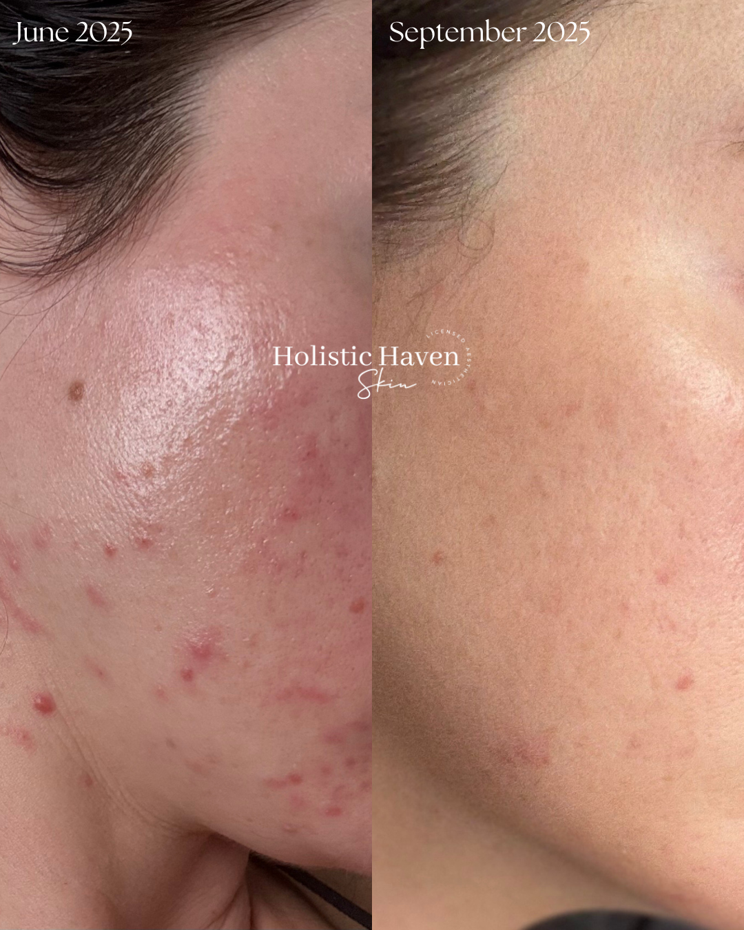 Client acne progress from June to September 2025