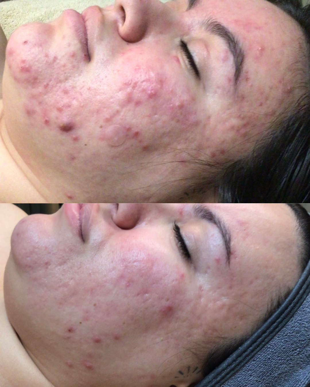 Client acne before and after treatment