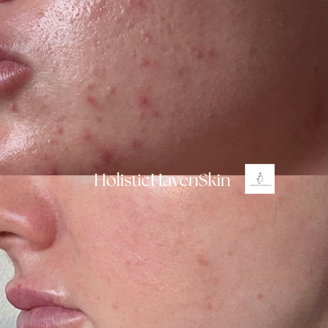 Close-up client acne treatment result