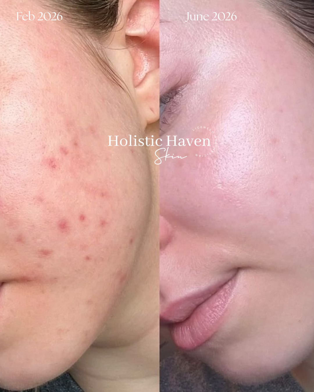Client acne progress from February to June 2026